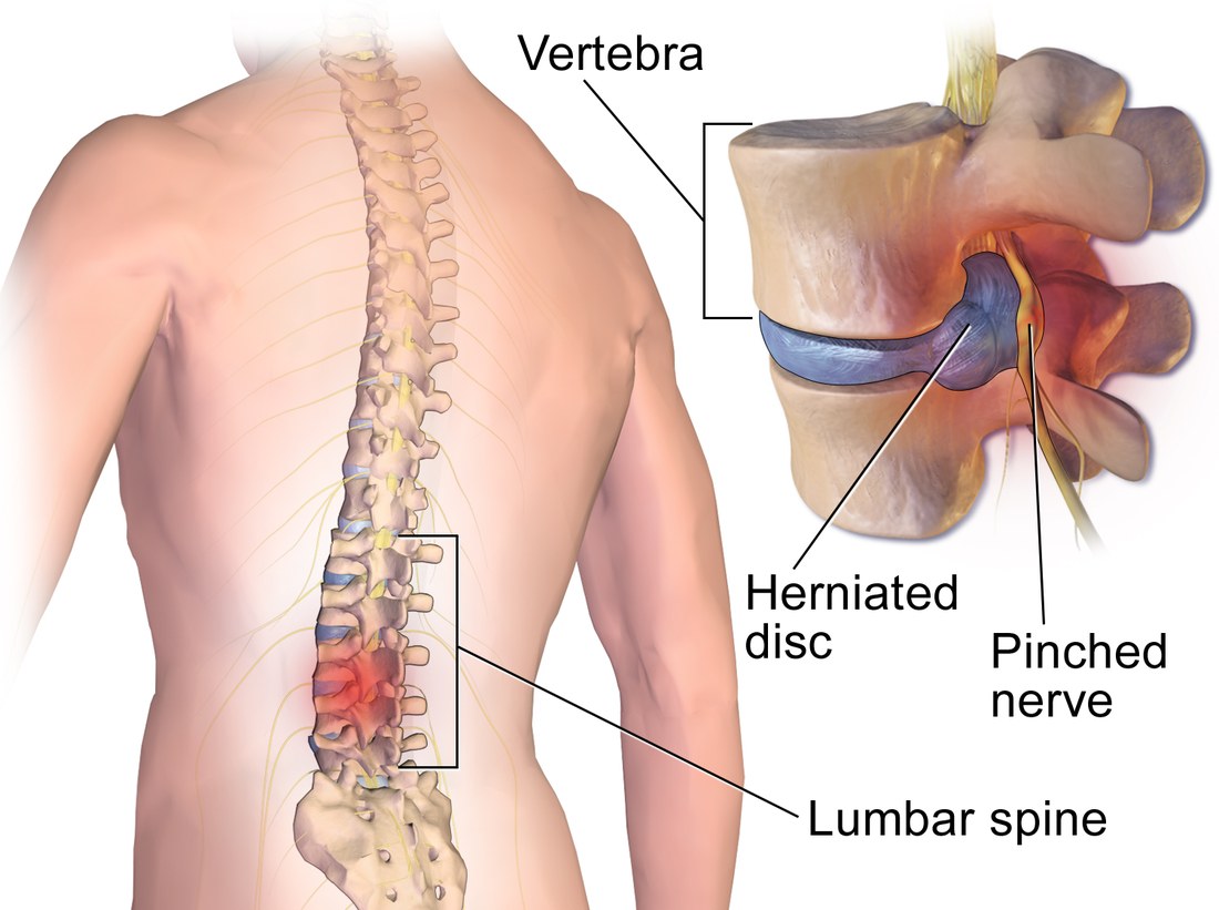 An illustration of a herniated lumbar disc, bulging out from between two vertebrae toward a spinal nerve.