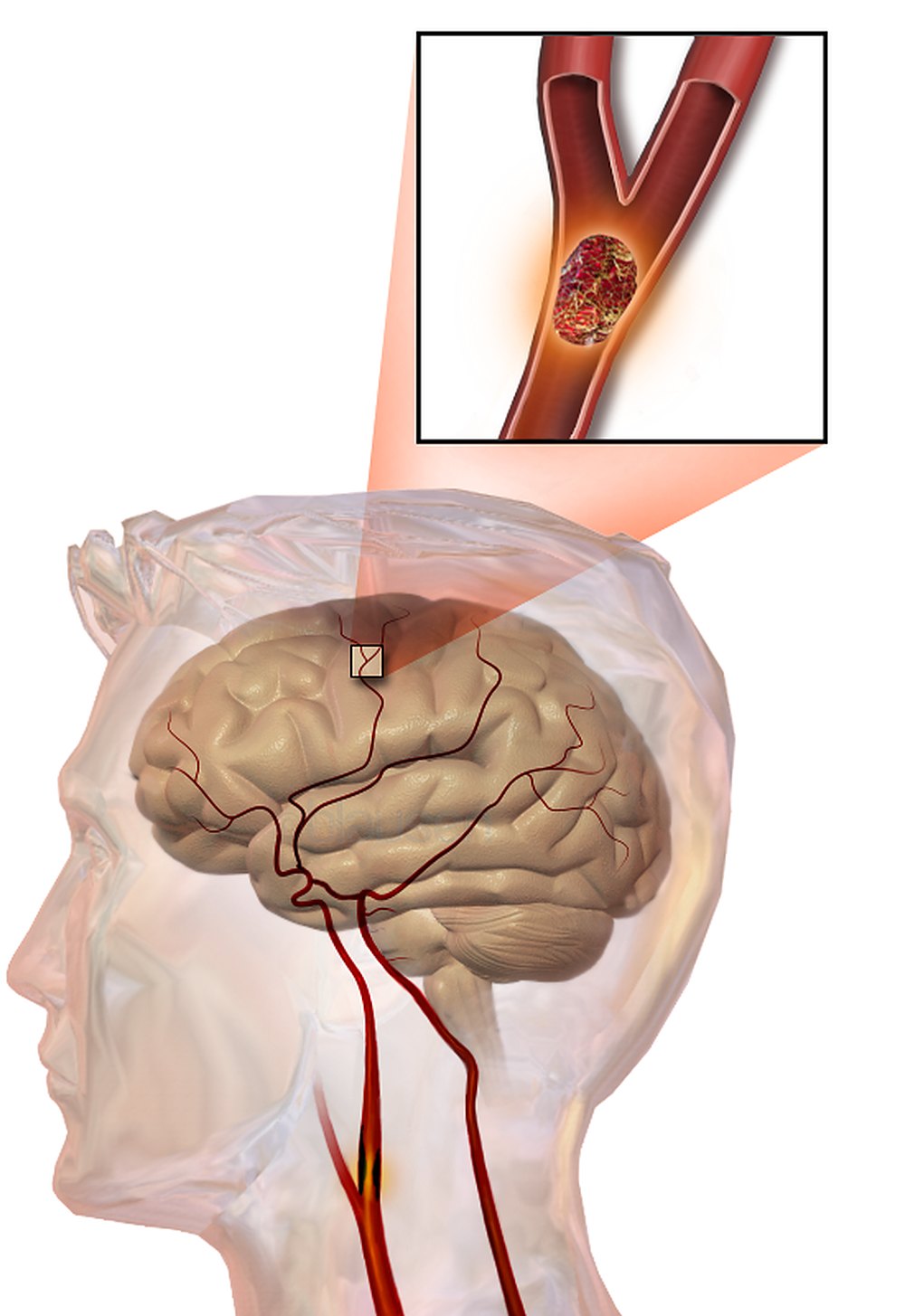 An illustration of a blood clot lodged in an artery of the brain, shown in a magnified inset above a transparent head.
